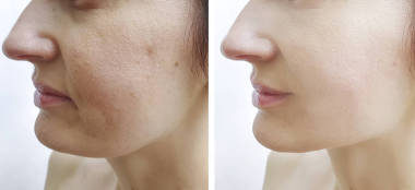 妇女在治疗前后都面临皱纹