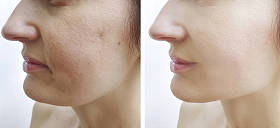 妇女在治疗前后都面临皱纹