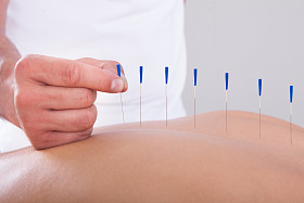 女人接受针灸治疗照片