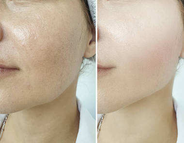 婦女皺紋面對治療前后