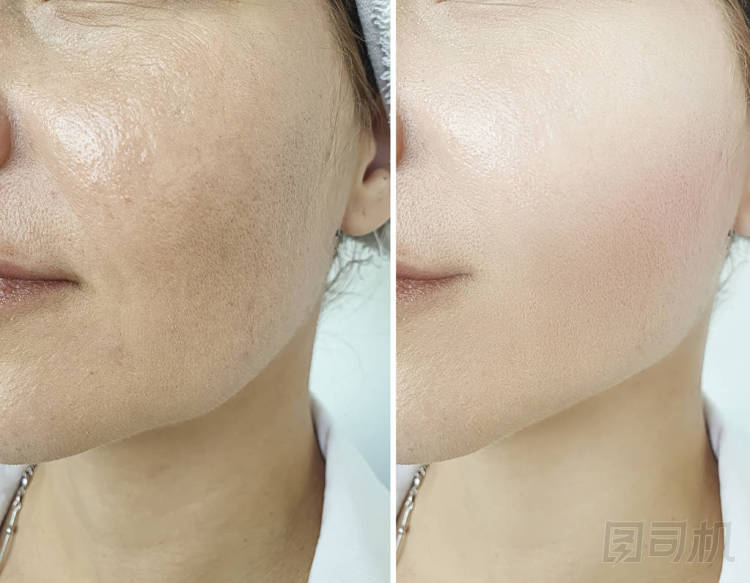 婦女皺紋面對(duì)治療前后