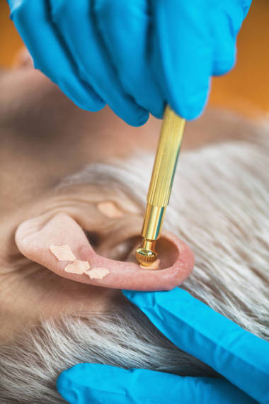 耳部治疗，或对人耳的眼膜治疗，特写。治疗师手应用针灸耳籽贴纸与钳子