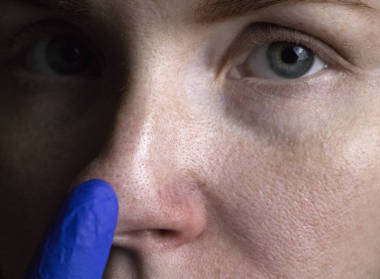 一個年輕女子鼻子上的割草病。痤瘡在臉上。由醫(yī)生進行檢查