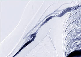 右臂的血管成形术、气球血管成形术和经皮腔内血管成形术(Pta)