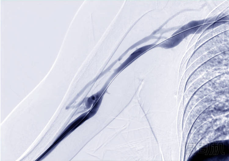 右臂的血管成形術(shù)、氣球血管成形術(shù)和經(jīng)皮腔內(nèi)血管成形術(shù)(Pta)