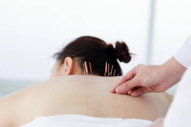 進(jìn)行針灸治療的醫(yī)生的手。 亞洲女性e