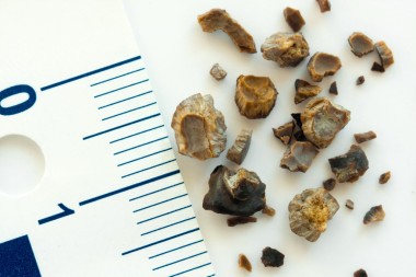 腎結(jié)石照片