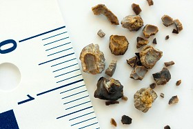 肾结石照片