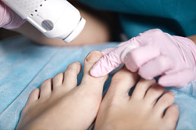 接受激光治疗她脚上的女人图片