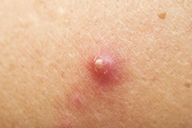 极端在人体皮肤上的疙瘩。宏