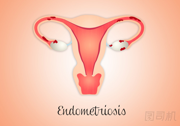 子宮內(nèi)膜異位癥