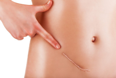 女人顯示瘢痕圖片