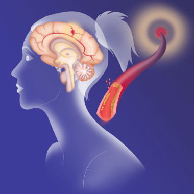 缺血性腦卒中的描述照片