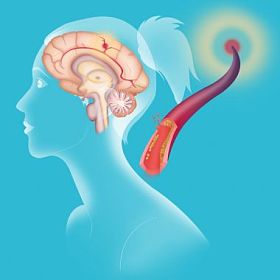 缺血性脑卒中的描述图片