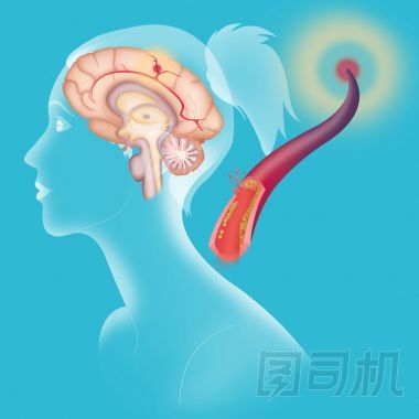 缺血性腦卒中的描述圖片