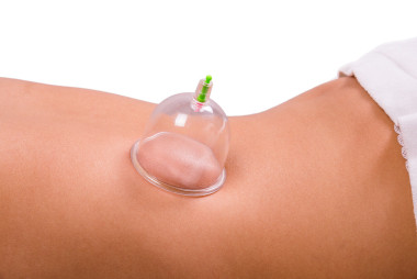 Cupping療法圖片