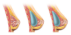 女人乳房植入物截面. 