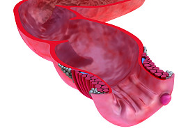 痔疮： 肛门疾病照片