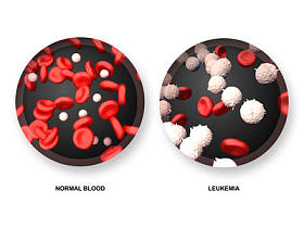 白血病 vs 正常的血液