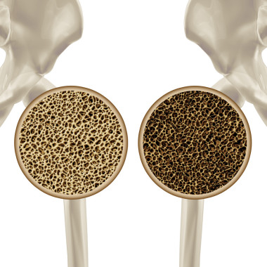 骨質(zhì)疏松癥