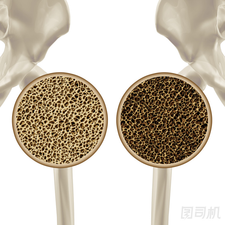 骨質(zhì)疏松癥