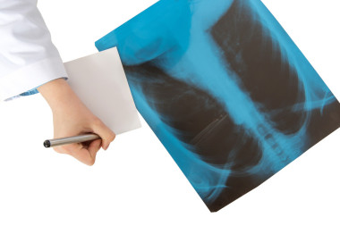 醫(yī)生寫(xiě)的人類肺部 x 線掃描的說(shuō)明