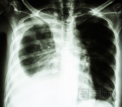 由于肺癌胸腔積液圖片