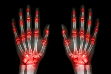 多個(gè)關(guān)節(jié)關(guān)節(jié)炎手 (痛風(fēng)、 類風(fēng)濕) 在黑色背景上