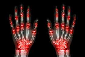 多个关节关节炎手 (痛风、 类风湿) 在黑色背景上