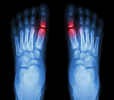 “類風(fēng)濕性關(guān)節(jié)炎，古蒂關(guān)節(jié)炎”兒童足部和超材料關(guān)節(jié)(大腳趾區(qū))關(guān)節(jié)炎的x光片