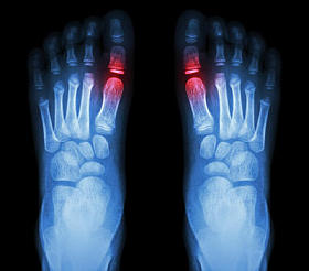 “类风湿性关节炎，古蒂关节炎”儿童足部和超材料关节(大脚趾区)关节炎的x光片