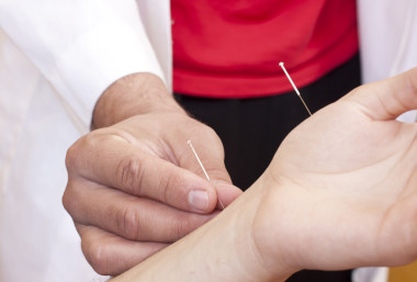 女人接受針灸
