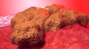 癌癥細(xì)胞腫瘤，3d 醫(yī)學(xué)插圖