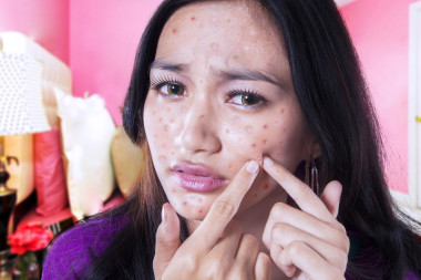 十幾歲的女孩，撫摸她的臉頰上的痤瘡