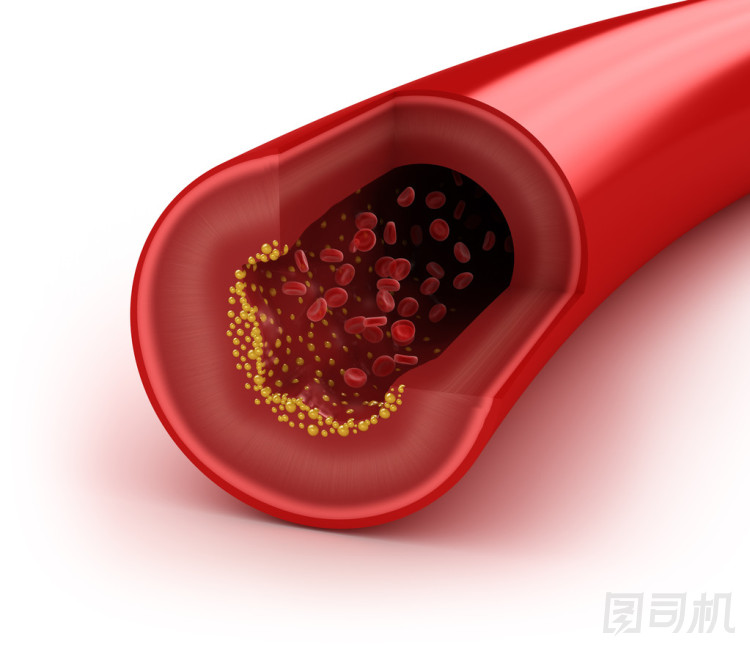 膽固醇斑塊的動(dòng)脈，概念上白色隔離