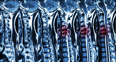 頸椎病合并椎間盤突出(頸椎MRI:顯示頸椎病合并椎間盤突出