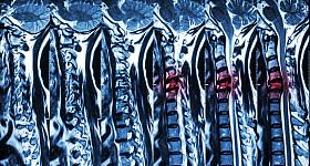 颈椎病合并椎间盘突出(颈椎MRI:显示颈椎病合并椎间盘突出