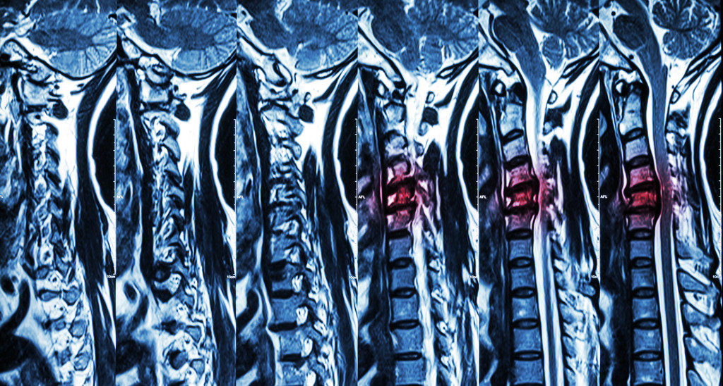 颈椎病合并椎间盘突出(颈椎MRI:显示颈椎病合并椎间盘突出