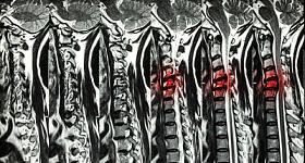 颈椎病合并椎间盘突出(颈椎MRI:显示颈椎病合并椎间盘突出