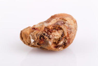 巨大腎結(jié)石30毫米