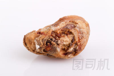 巨大腎結(jié)石30毫米