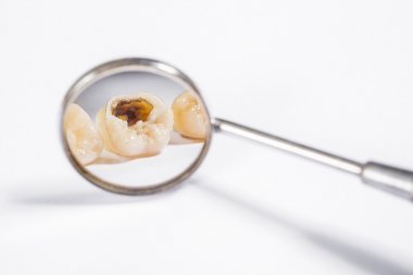 牙科植入物和假牙预防去看牙医