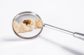 牙科植入物和假牙预防去看牙医