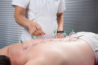 Cupping療法圖片