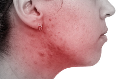 女性有她的皮肤问题图片