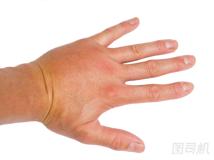 男性的人顯示腫脹的關(guān)節(jié)左手上 wh 孤立