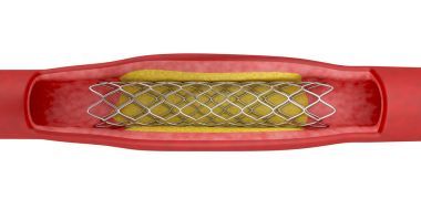 血管成形術(shù)與支架置入術(shù)