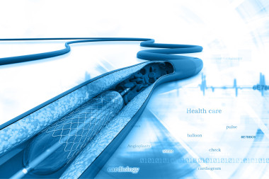 放置一个气球支架血管成形术