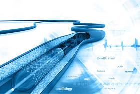 放置一个气球支架血管成形术