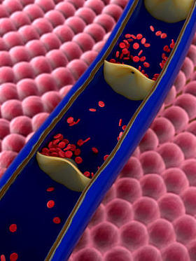 在血管中的血凝块